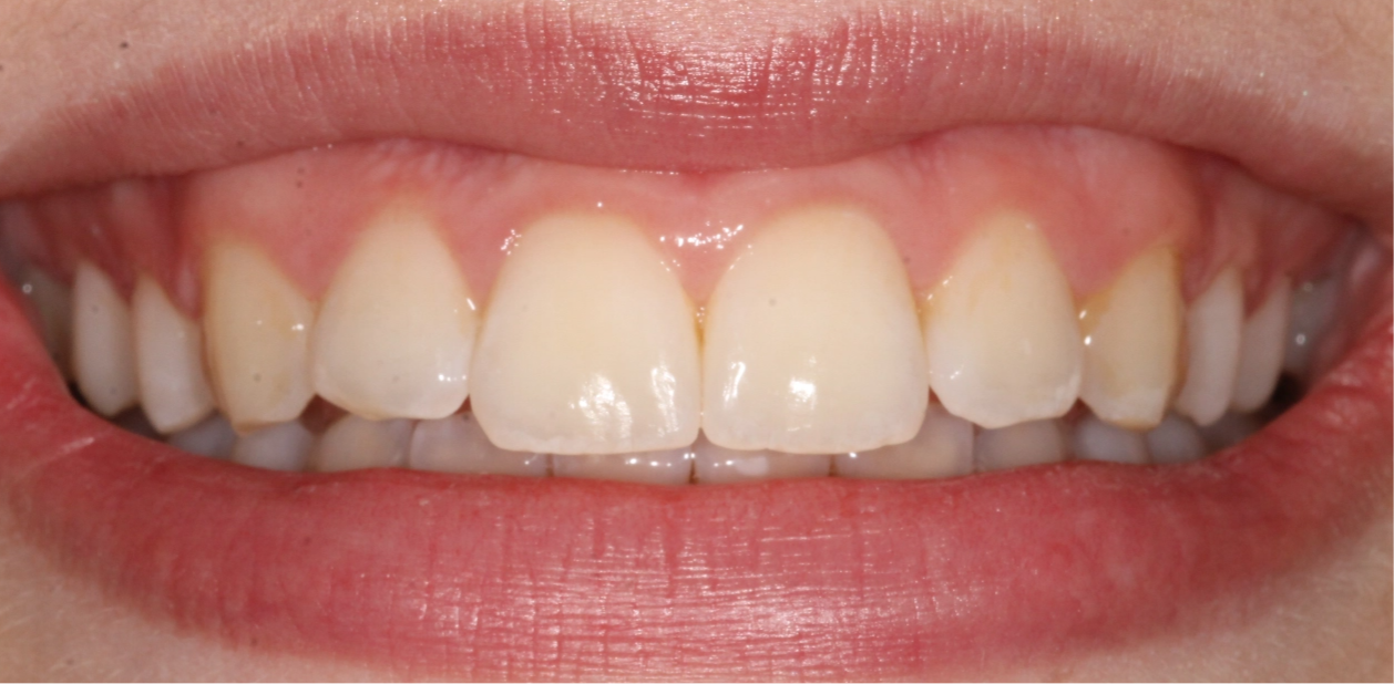 orthodontic-after-02