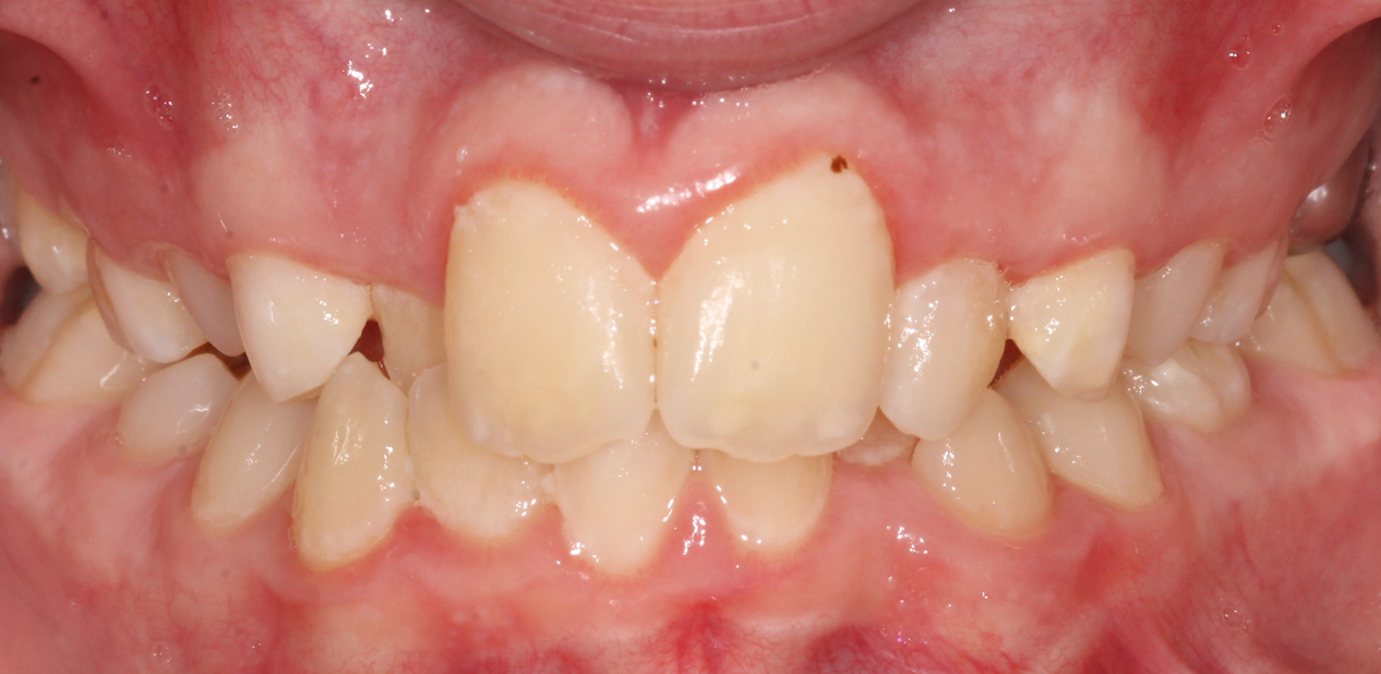 orthodontic-before-01