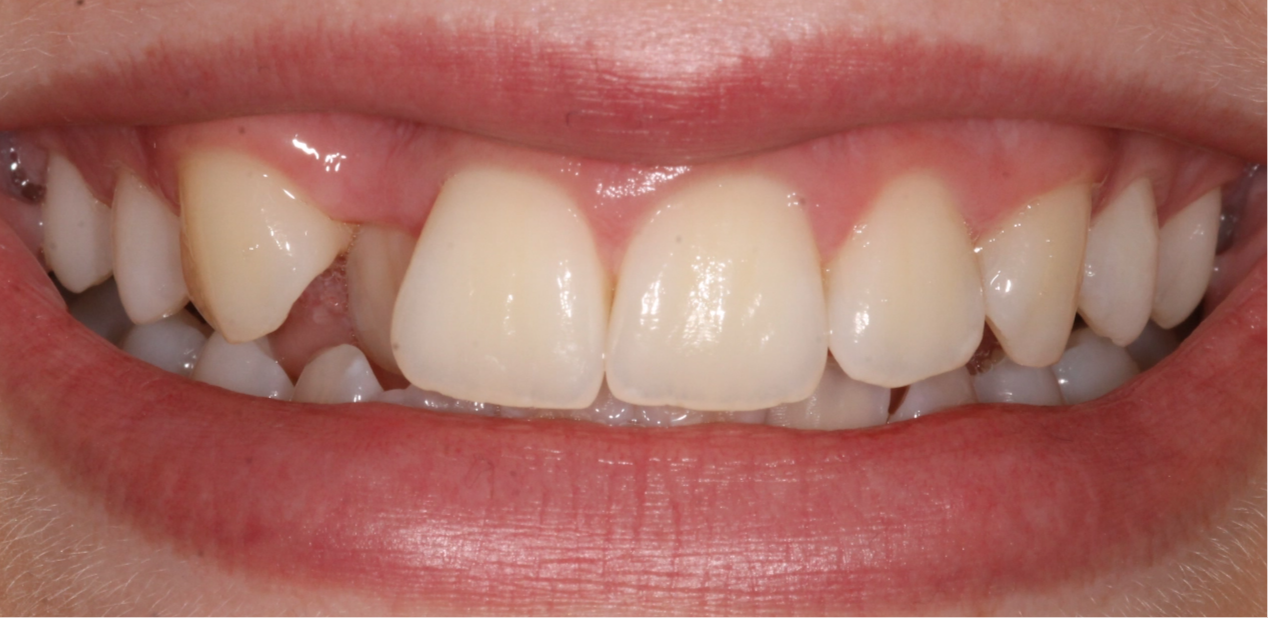 orthodontic-before-02