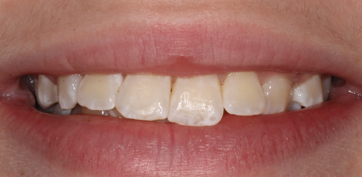orthodontic-before-03