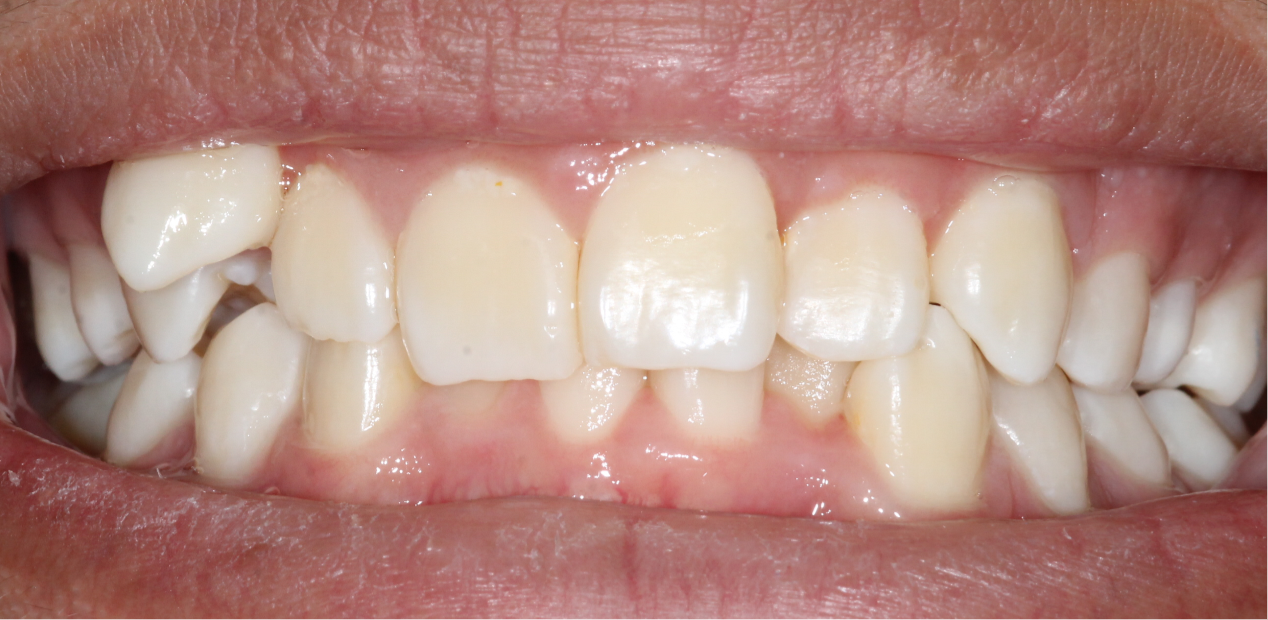 orthodontic-before-04
