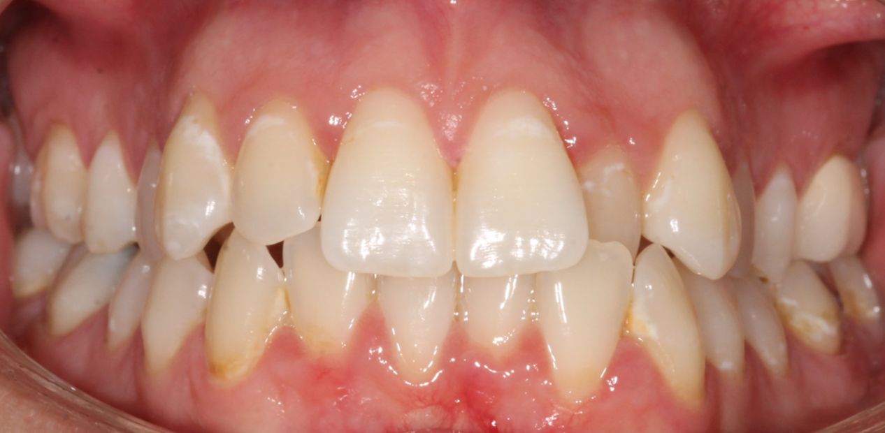 orthodontic-before-05