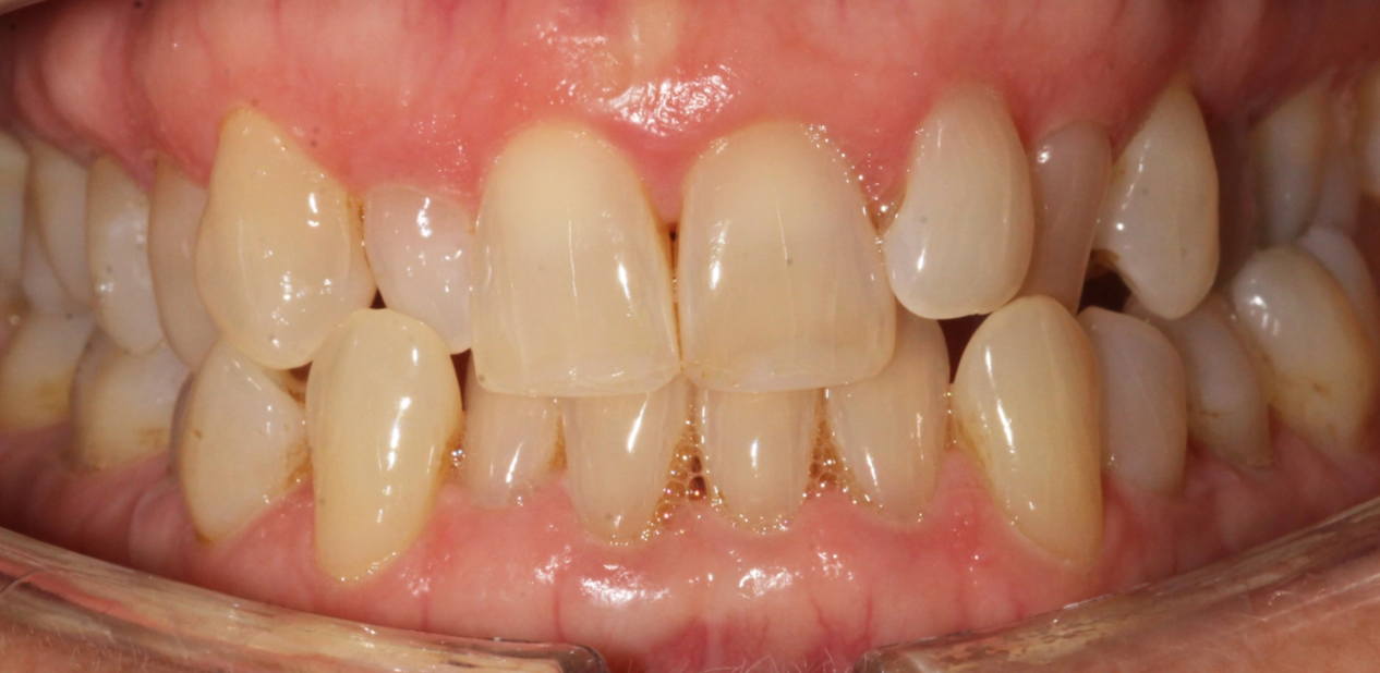 orthodontic-before-06